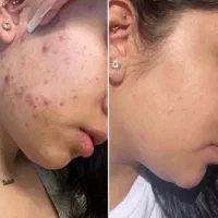 فیشال و‌جوانسازی  و آموزش تحت نظارت پزشک
