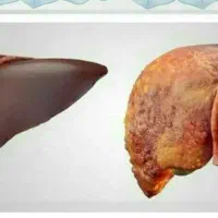 چرا برای بیماری کبد هزینه زیاد میکنید
