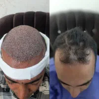 کاشت مو و ابرو به روش میکروگرافت و بلفاروپلاستی