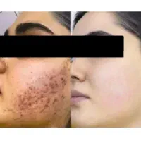 بهبود کامل کک و مک و جای جوش