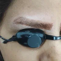 تزریق بوتاکس و ژل