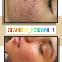 فیشال درمانی وپاکسازی پوست برای خانم و آقا سیرجان