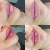 تزریق ژل و بوتاکس حرفه ایی