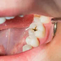 خدمات ترمیم پوسیدگی دندان در دانشکده دندانپزشکی