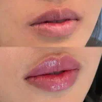 تزریق ژل بوتاکس مزو پی‌آر‌پی