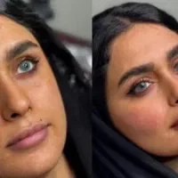 بوتاکس ۴۵۰ فیلر ۴۰۰ فقط تا ۳ روز توسط دکتر