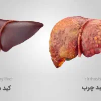 مشاوره کبد چرب