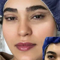 تخفیف ویژه بلفاروپلاستی پلک لیفت دایرکت ابرو