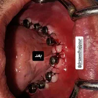 کاشت دندان توسط ایمپلنتولوژیست باتجربه