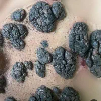 رفع زگیل و خال گوشتی در کمتر از ۲ هفته
