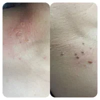 خال برداری،برداشتن منگوله،سوراخ کردن گوش