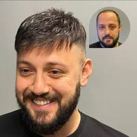 پروتز مو و ترمیم مو  اصفهان