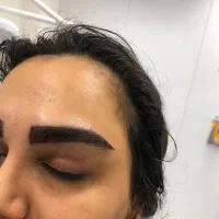 کاشت مو ابرو ریش سبیل