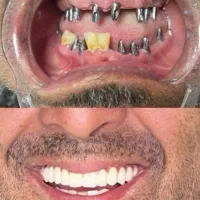 ایمپلنت با وام ۵۰۰ ملیونی