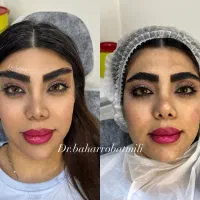 مدل ژل فیلر بوتاکس انزیم مزو