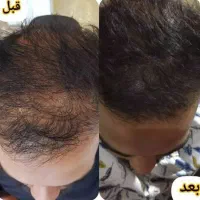 وقت خداحافظی با ریزش موهات رسیده