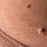 تنها روش رفع دائمی زگیل