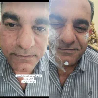 آموزش فیلر و بوتاکس و مزو تراپی
