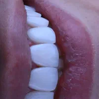 خدمات دندانپزشکی نصف هزینه فرانشیز بیمه تکمیلی