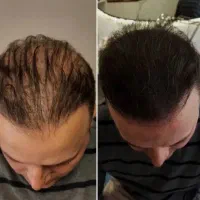 رویش ریش و موهاتو به ما بسپار