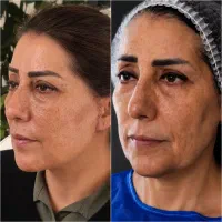 مینی لیفت صورت گردن شقیقه،ساکشن،بلفارو اپی کانتو