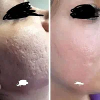 پوست صاف وبدون منافذداشته باش با کمترین هزینه