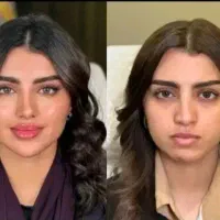 ساکشن غبغب با متد«ایرانا» دکتر کامبیز محمدپور