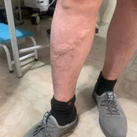 رهایی از واریس مویرگی پا به راحتی با تزریق آمپول