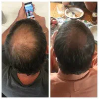 قطع ریزش مو