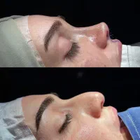 جراحی بینی توسط متخصص گوش و حلق بینی پرداخت اقساطی