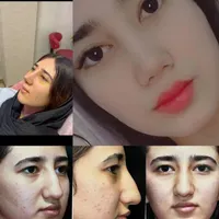 عمل بینی فقط۱۷ کلینیک +جراحی +بیهوشی|خدمات آرایشگری و زیبایی|تهران, زعفرانیه|دیوار