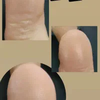 پدیکور درمانی رفع ترک های عمیق