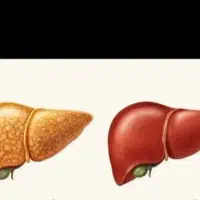 کبد چرب مرگ خاموش