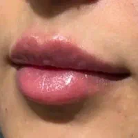 به تعدادی مدل جهت تزریق ژل و بوتاکس نیازمندیم