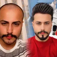 کاشت مو شیراز در خرم آباد(بیرو کاشت) اقساط