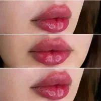 ژل لب 790 بوتاکس چشم گربه ای 290.فول فیس میدفیس