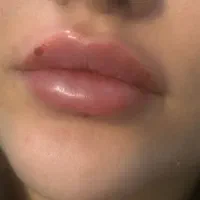 تزریق مزوژل  جوانساز فقط دو و نیم میلیون توسط پزشک