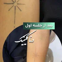 پاک کردن خالکوبی، تتو بدن و ابرو با لیزر کیوسوئیچ