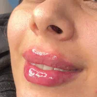 خدمات تزریق ،اولین مرکز تخصصی لب
