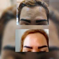 تزریق بوتاکس. مزوتراپی. فیلر