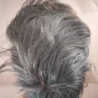 پروتز مو مردانه