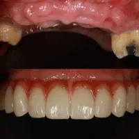 دندان پزشکی اوردنچر ایمپلنت دوفک فقط127اقساطی