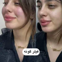 تزریقات فول فیس فیلر اودری۶۵۰۰