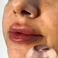 تزریق فیلر و بوتاکس توسط پزشک با بازگشت هزینه