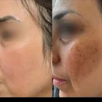 کرم تخصصی ضدلک و ضدجوش.فرمولاسیون پیشرفته