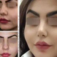 جشنواره محدود بینی دراهواز۲۵ت تااخرهفته