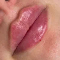 تخفیف ویژه مزوژل لوکسیوا۲/۹۵۰/۰۰۰ژل،بوتاکس،فیشیال
