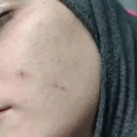 درمان انواع زگیل‌ تناسلی (hpv) و خال و لک در منزل