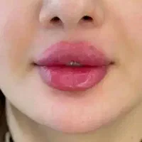 جشنواره فیلر/ژل(فقط850تا فردا)درمطب/پزشک تضمینی