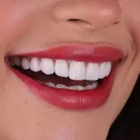 ایمپلنت دندان از ۱۲/۶۰۰ بصورت محدودبااقساط ویژه